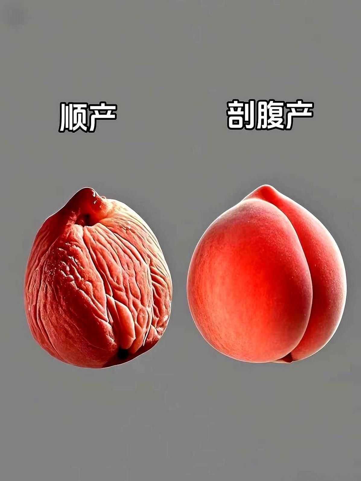 孕妈必看！顺产or剖腹产